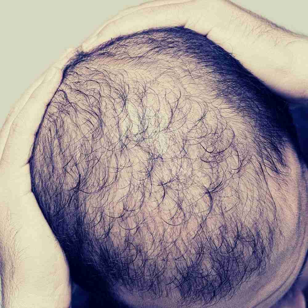 male pattern hair loss